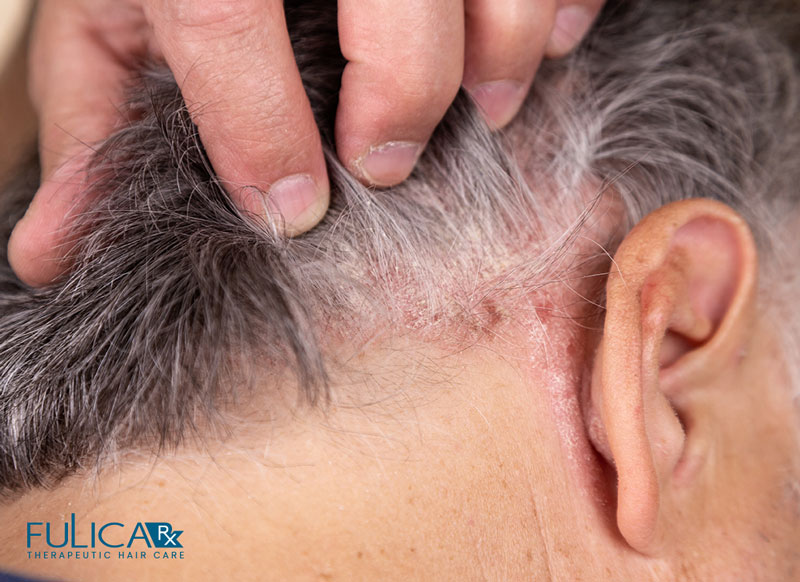 بهترین شامپو برای پسوریازیس پوست سر