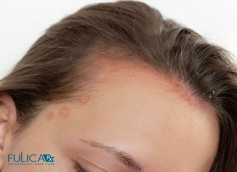 کنترل درماتیت سبورئیک با شامپو سولفاسال